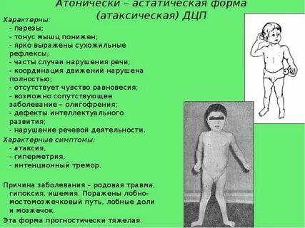 Речевые расстройства при дцп