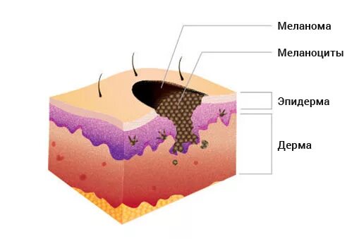 Распад кожи. Строение родинки гистология. Строение невуса гистология.