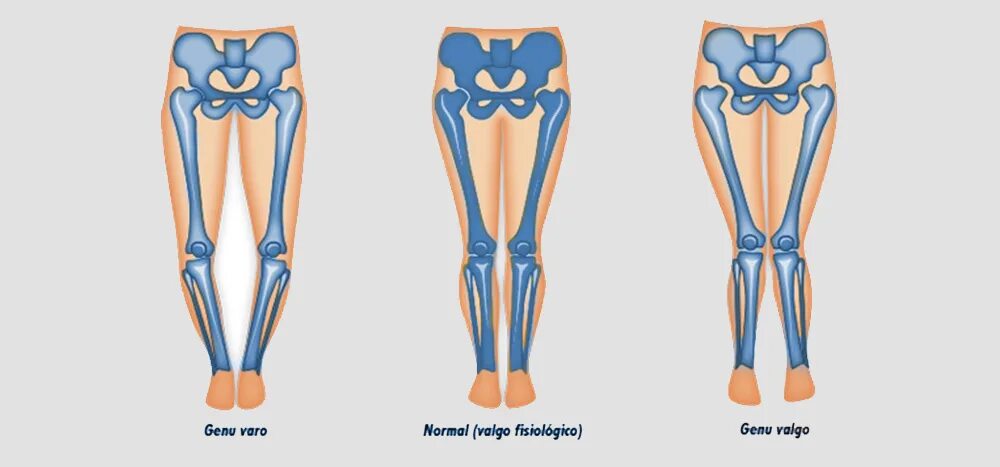 Варусная деформация коленных суставов. Плоско-вальгусная деформация стоп. Вальгусная деформация плюснефалангового сустава. Вальгусная деформация большого пальца стопы( hallux valgus. Варус вальгусная деформация.