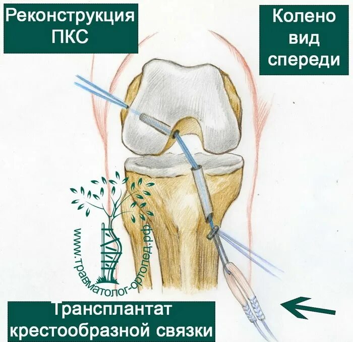 Крестовидная коленная связка. Разрыв связок ПКС коленного сустава. Повреждение крестообразной связки колена. Крестообразные связки коленного сустава схема. Разрыв связок коленного сустава ПКС операция.