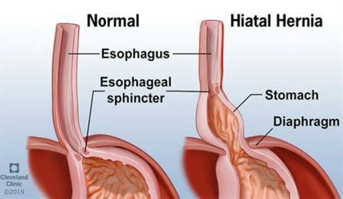 Грыжа пищеводного отверстия диафрагмы. Хиатальная пищеводная грыжа. Хиатальная грыжа пищеводного отверстия диафрагмы.