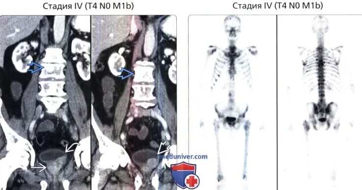 Вылечили рак 4 стадии с метастазами. Предстательной железы метастазы в костях. Сцинтиграфия метастазы в кости. Онкология простаты метастазы в костях. Сцинтиграфия костей метастазы РМЖ.