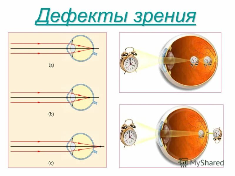 Глаз и зрение физика 9. Дефекты зрения. Дефекты зрения схемы. Коррекция линзами дефектов зрения. Дефекты зрения физика.