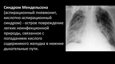 Аспирационный синдром у новорожденных