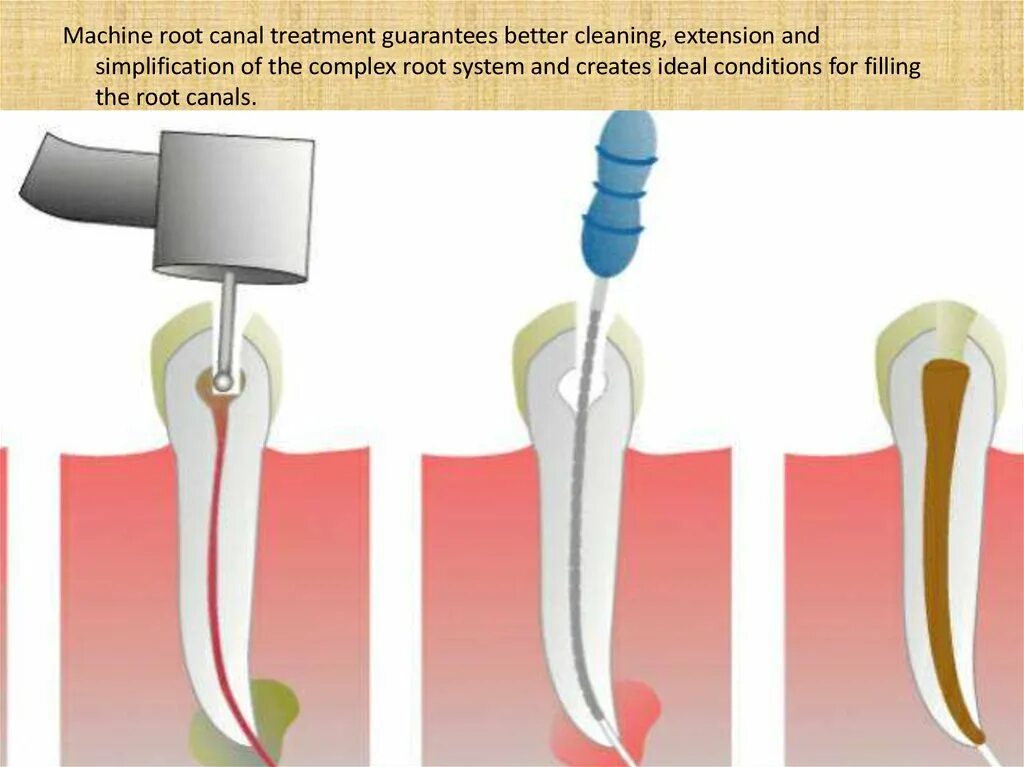 Как вытаскивать нерв. Извлечение зубного нерва. Извлеченный зубной нерв. Как вытаскивать нерв. Как вытаскивать нерв.