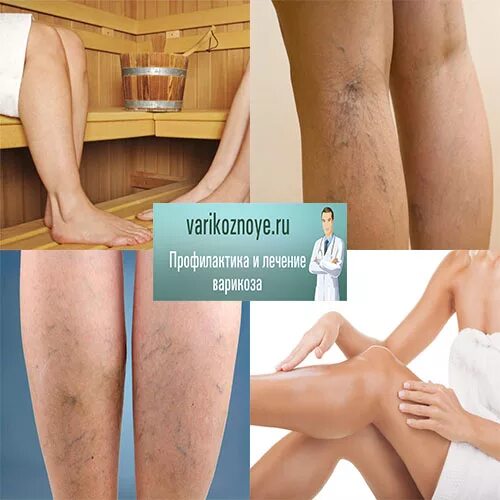 Женская баня. Массаж ног при варикозе. Венозное расширение вен. Можно париться при варикозе ног. Памятка варикозное расширение вен нижних конечностей.