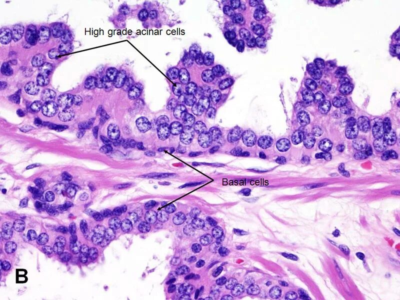 Интраэпителиальная неоплазия предстательной железы. Аденокарцинома предстательной железы гистология. Простатическая интраэпителиальная неоплазия гистология. Аденома простаты гистология.