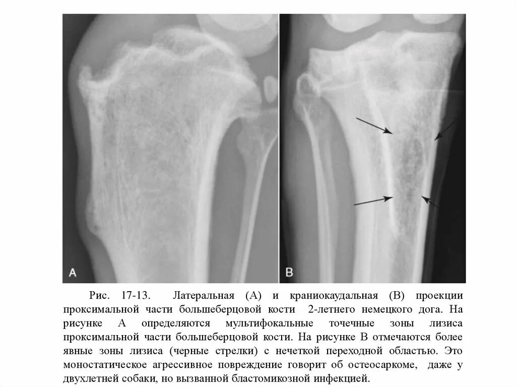 Опухоль кости – экзостоз.. Энхондрома диафиза бедренной кости. Периостоз бугристости большеберцовой кости. Метадиафиз большеберцовой кости. Контузионные изменения кости