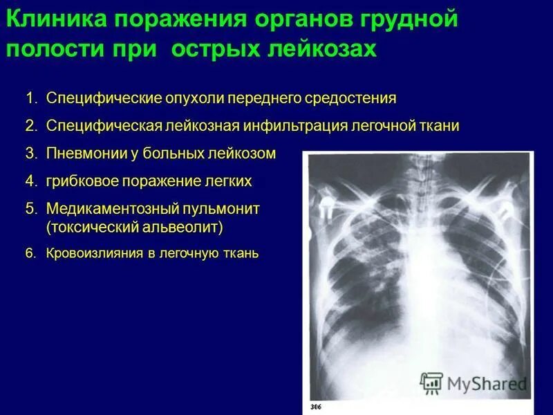 Поражение легочных тканей. Поражение легких при лейкозе кт. Поражение средостения. Лейкозная инфильтрация легких.