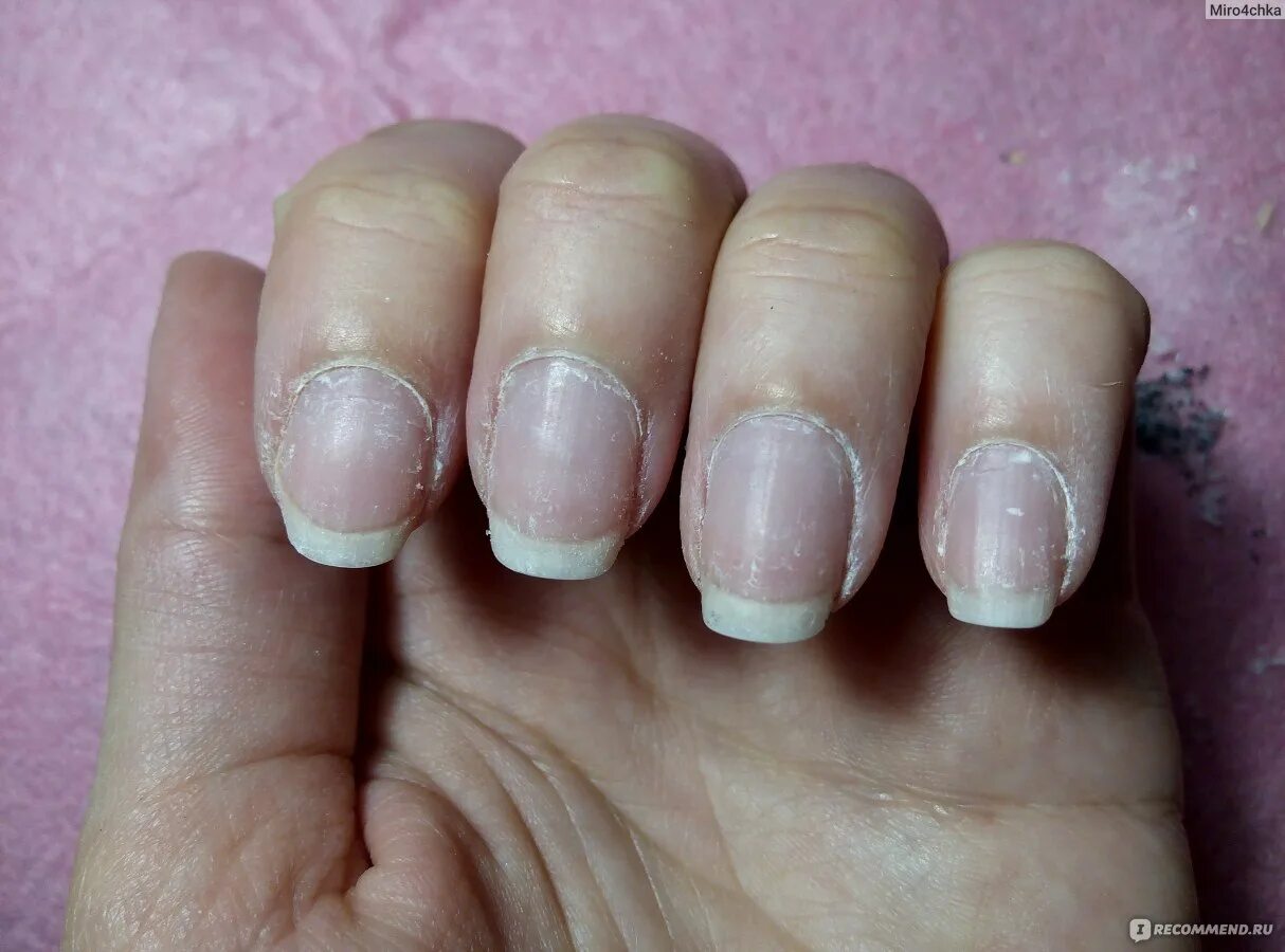 Болят ногти после снятия гель. Ногти после снятия гель. Ногти после снятия гел. Как выглядят ногти после гель лака.