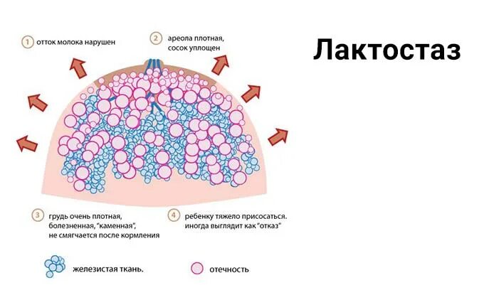 Что такое лактостаз. Лактостаз. как понять что застой грудного молока. лактостаз этиология.