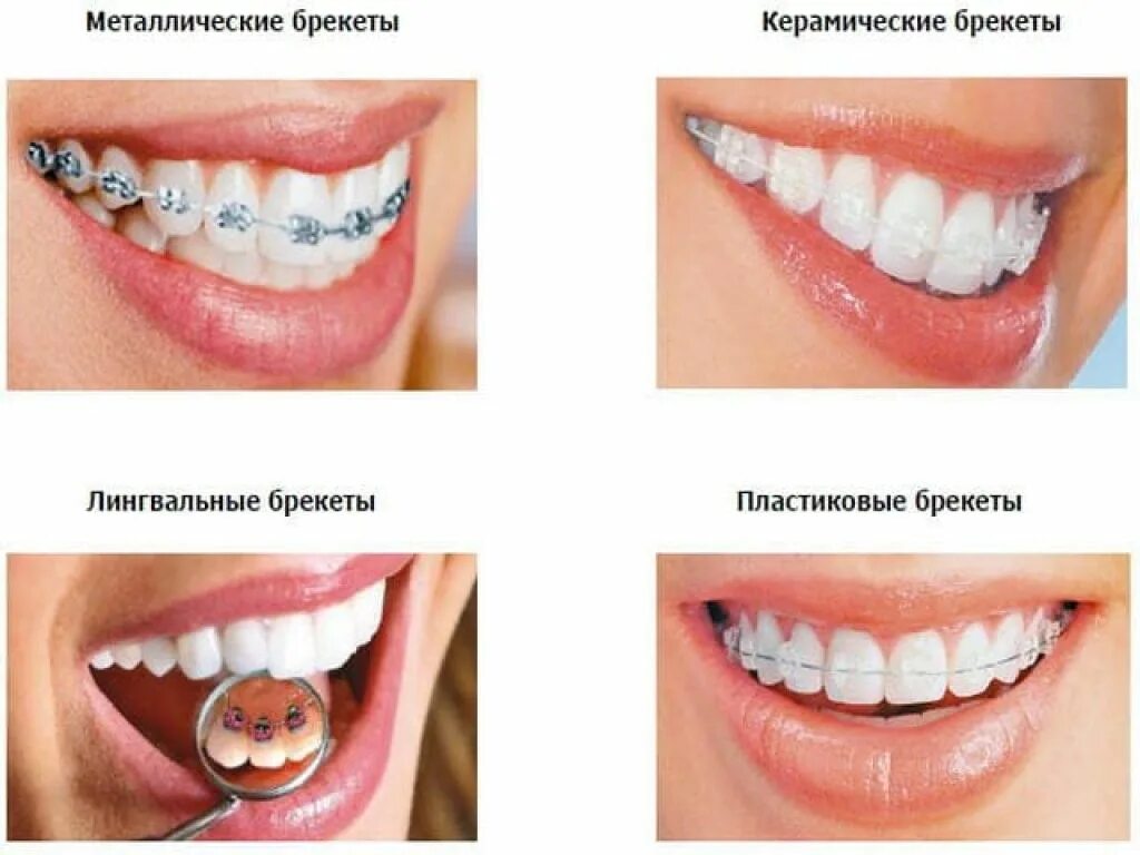 Сколько времени носят брекеты. Брекеты. Лингвальные брекет-системы.