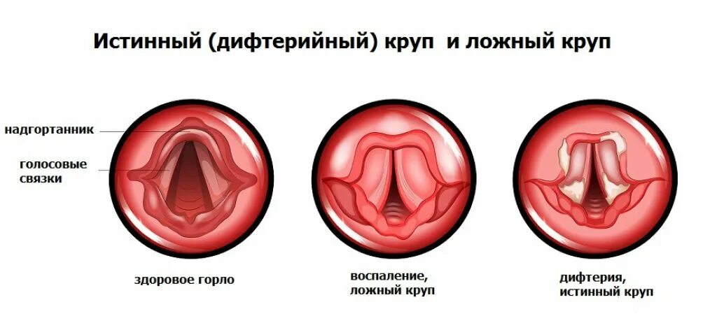 Хриплые голосовые связки. Дифтерийный круп и ложный круп. Дифтерия гортани истинный круп. Дифтерия истинный и ложный круп. Истинный круп (дифтерия) ложный круп.