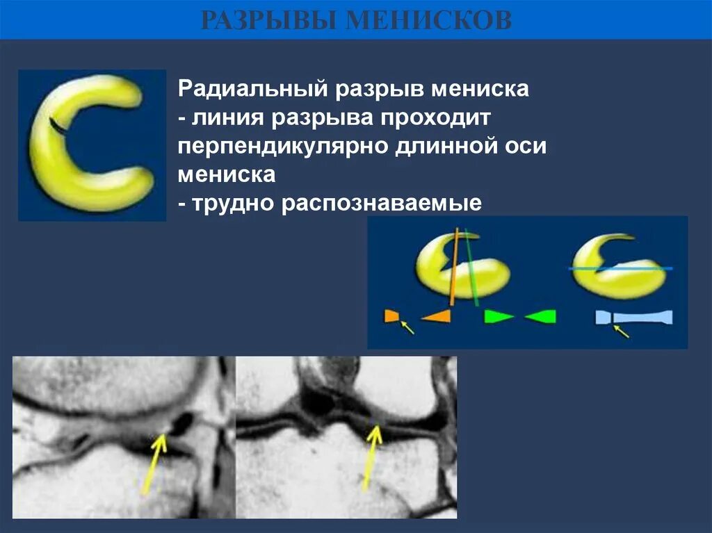 Разрыв мениска мрт. Повреждение мениска коленного сустава мрт. Лоскутный горизонтальный разрыв мениска мрт. Лоскутный разрыв медиального мениска. Разрыв мениска 3 степени.