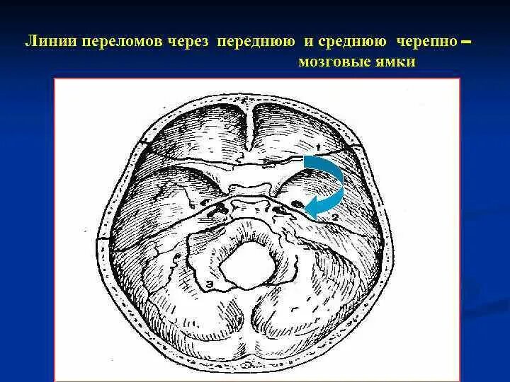 Сообщения передней черепной ямки. Задняя черепная ямка анатомия. черепно мозговые ямки. средняя черепная ямка.