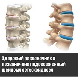 Аппликатор при шейном остеохондрозе