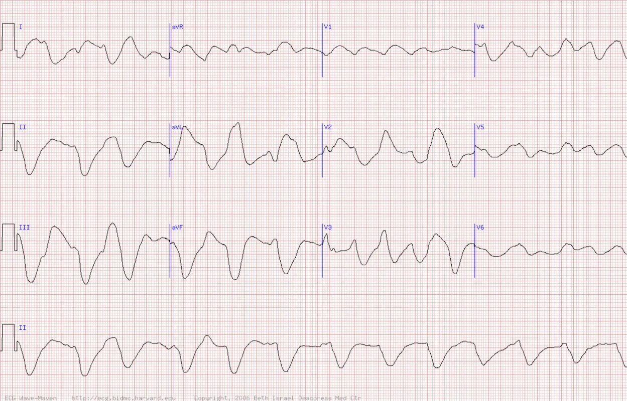 Qrs m 30