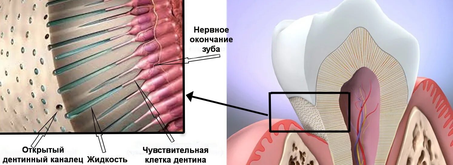 Зубной дентин. Дентин и дентинные канальцы. гиперчувствительность зубов дентинные канальцы. дентинные трубочки и канальцы. дентинные канальцы зуба.