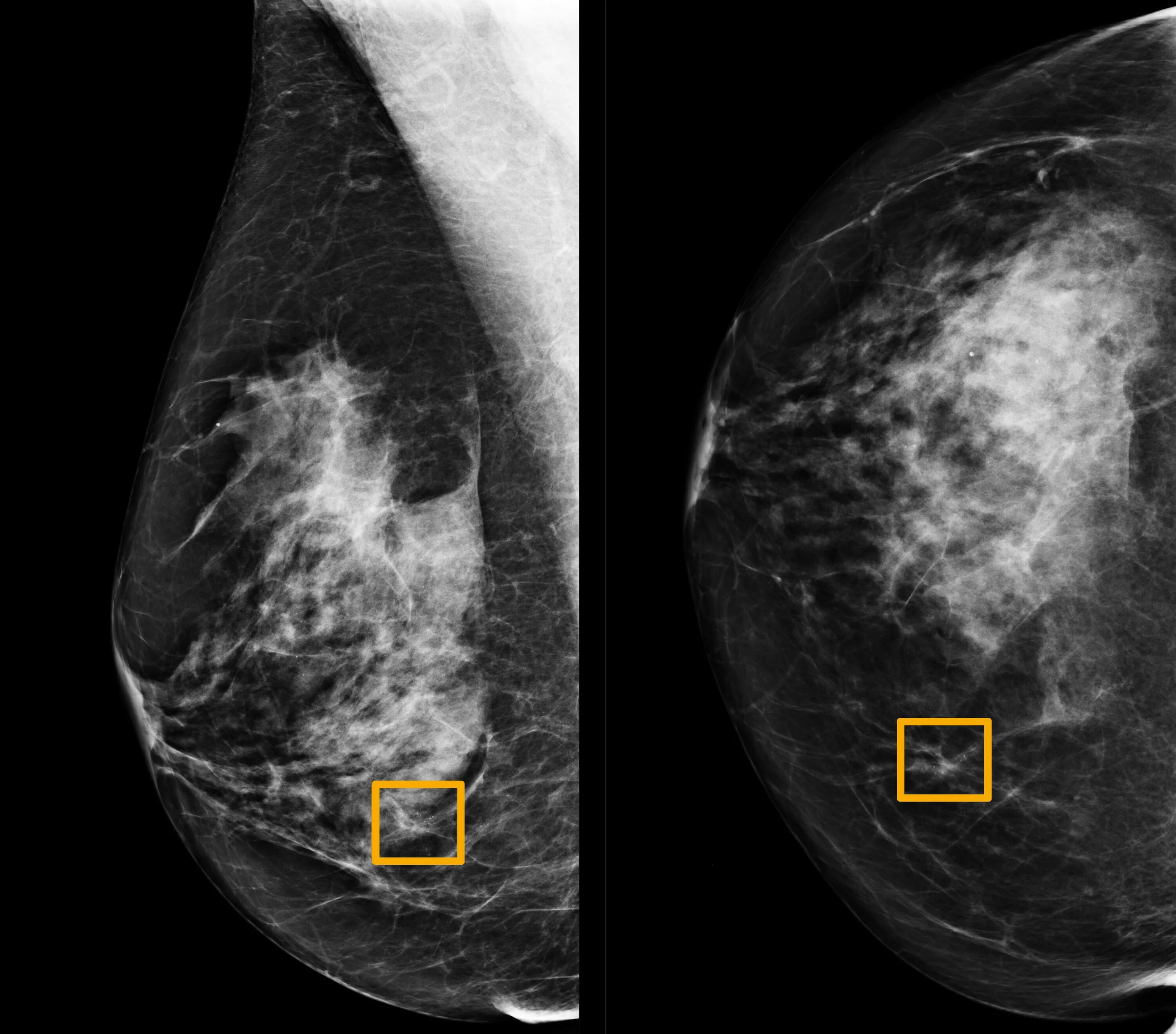 Brustkrebs mit BRCA1-Mutation: Bessere Prognose nach Ovarektomie