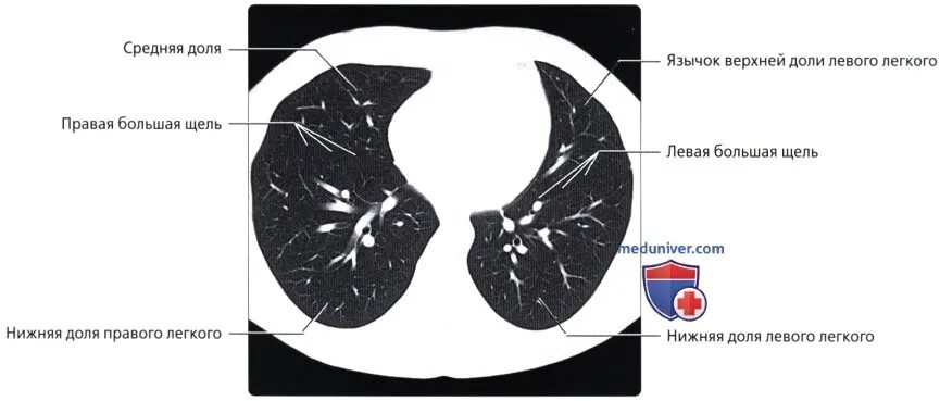 Доли легкого на кт. Сегменты легкого на кт схема. Язычковые сегменты левого легкого на кт. Кт анатомия легких по сегментам. Сегменты лёгких на кт.