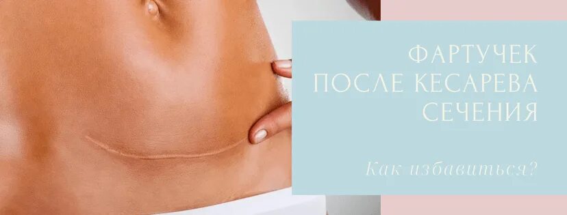 Шрам после кесарева сечения. Фартук на животе после кесарева. Шрам после кесарева сечения. Lpg массаж после кесарева сечения. Шов с валиком после кесарева.