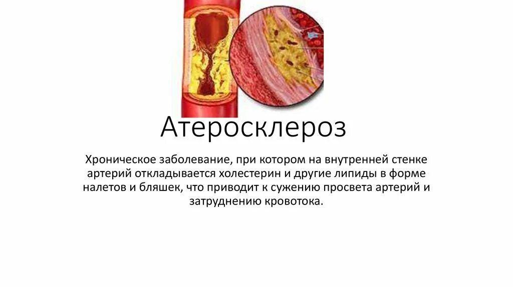 История болезни атеросклеротический