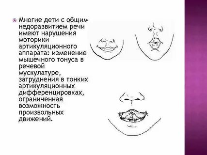 Нарушение речевого аппарата