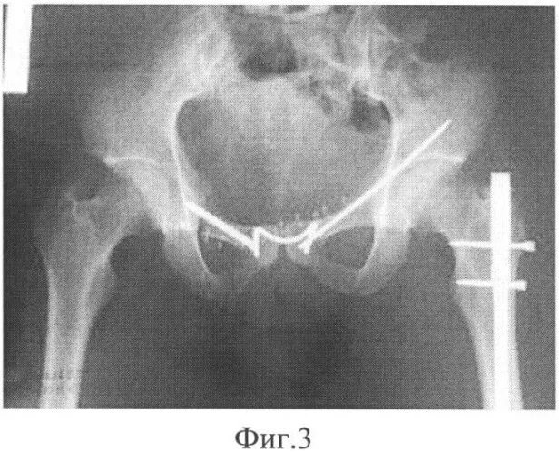 Разрыв сочленений. Лонное сочленение рентген. Перелом лонного сочленения рентген. Разрыв лонного сочленения рентген. Артродез лонного сочленения.
