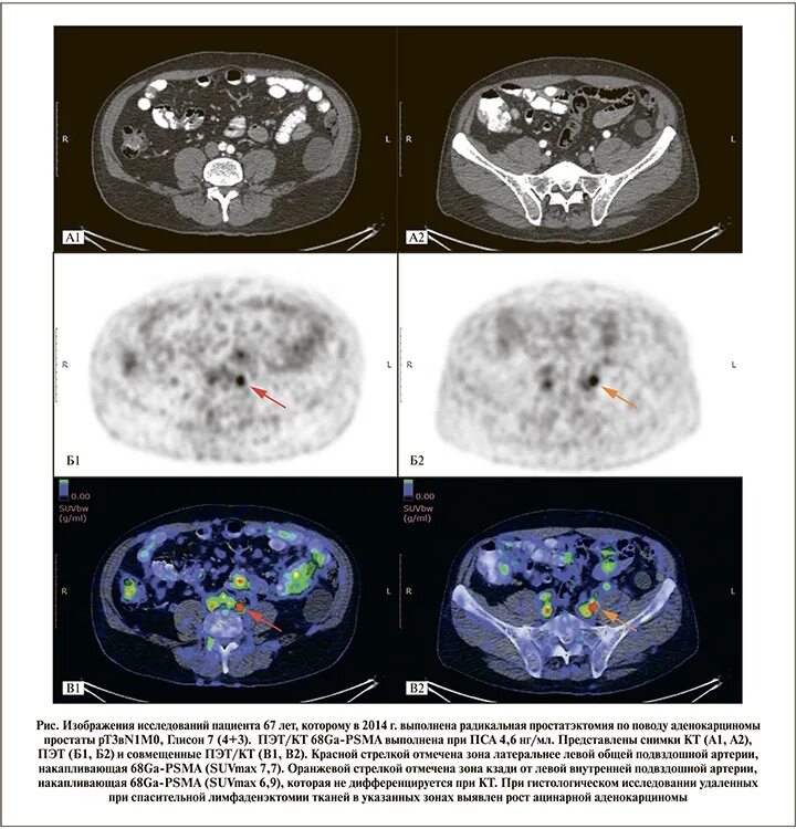 ПЭТ кт предстательной железы с ПСМА 68. ПЭТ/кт Discovery Pet/CT 610. Как пройти пэт кт