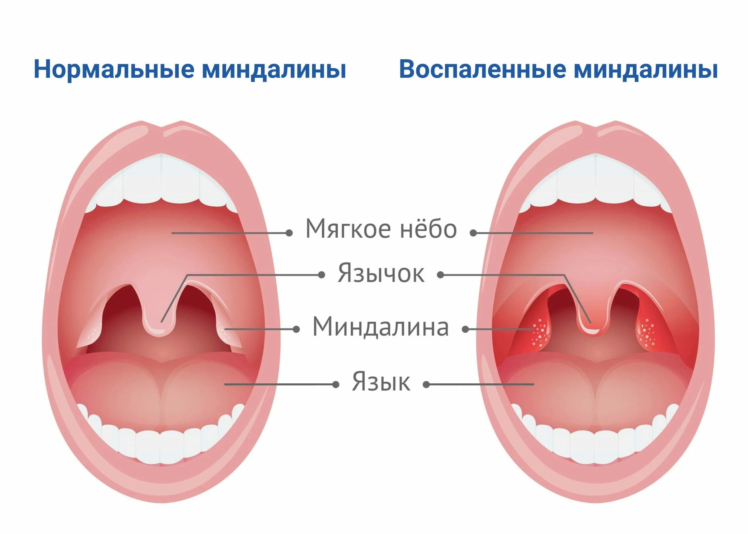 Строение аденоиды небные миндалины. Поверхность небных миндалин. Ангина небных миндалин. Аденоиды гланды и миндалины у детей.