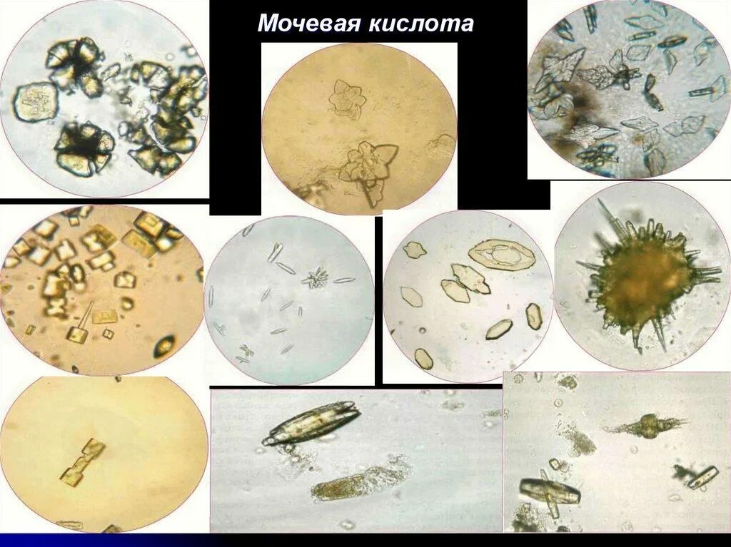 Повышен цистин в моче. Микроскопия мочи Кристаллы мочевой кислоты. Соли мочевой кислоты микроскопия. Мочевая кислота микроскопия. Кристаллы мочевой кислоты в Кале.