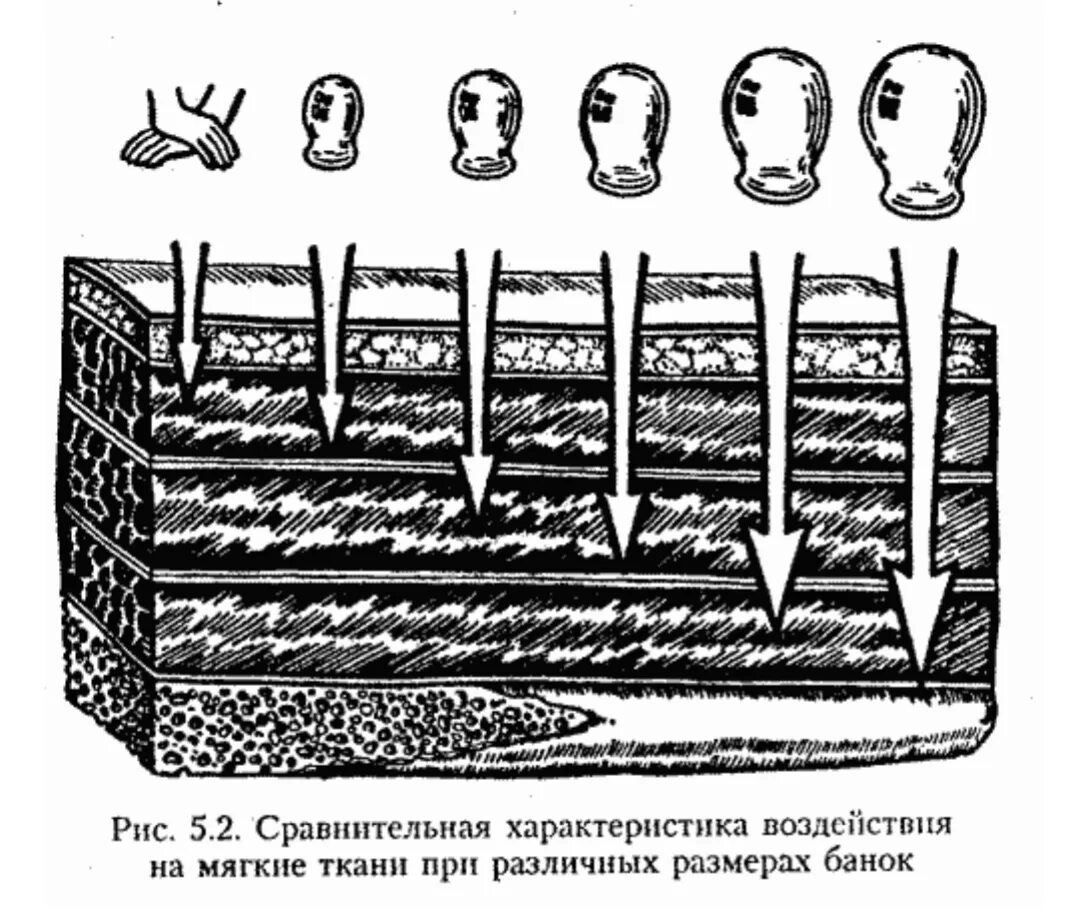 Действие банок. Воздействие вакуумного массажа на кожу. Механизм действия медицинских банок. Механизм действия вакуумного массажа. Вакуум терапия механизм влияния.