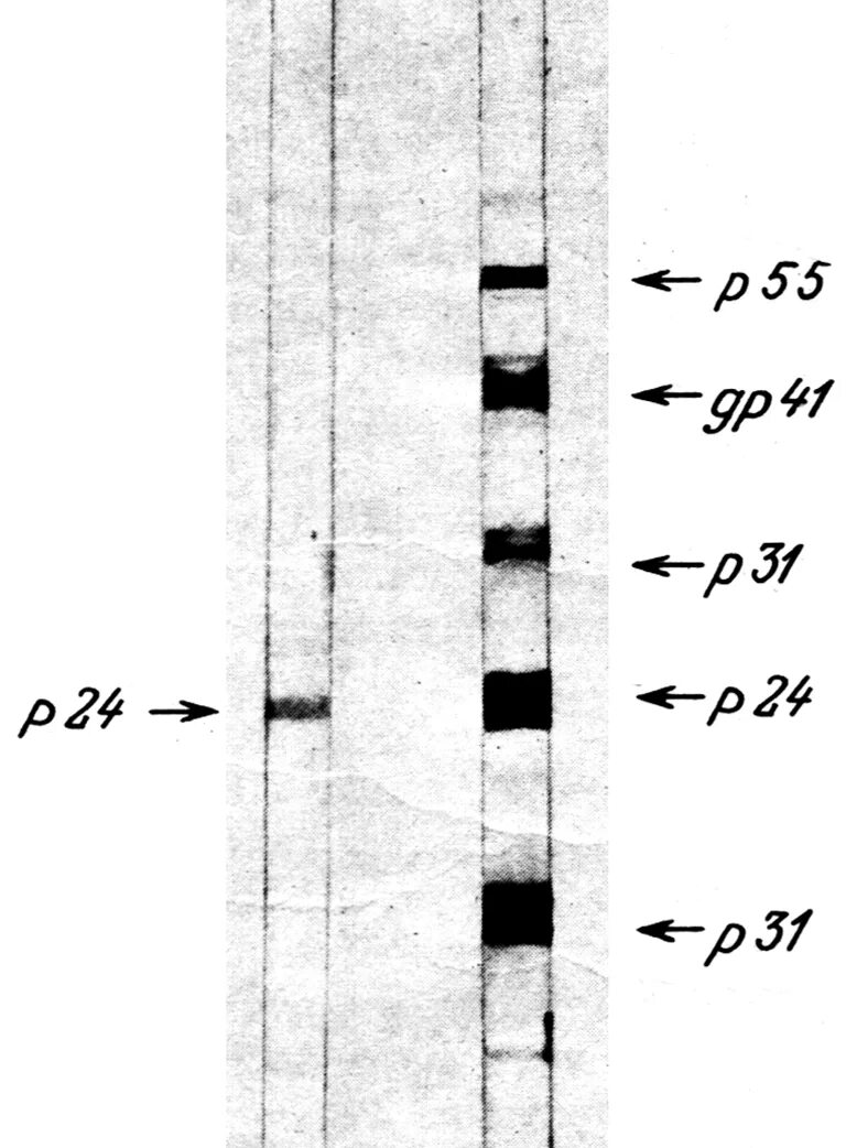 Иммуноблоттинг ВИЧ инфекции. Диагностика ВИЧ иммуноблот. Иммуноблот ВИЧ интерпретация результатов. Иммуноблот при ВИЧ.