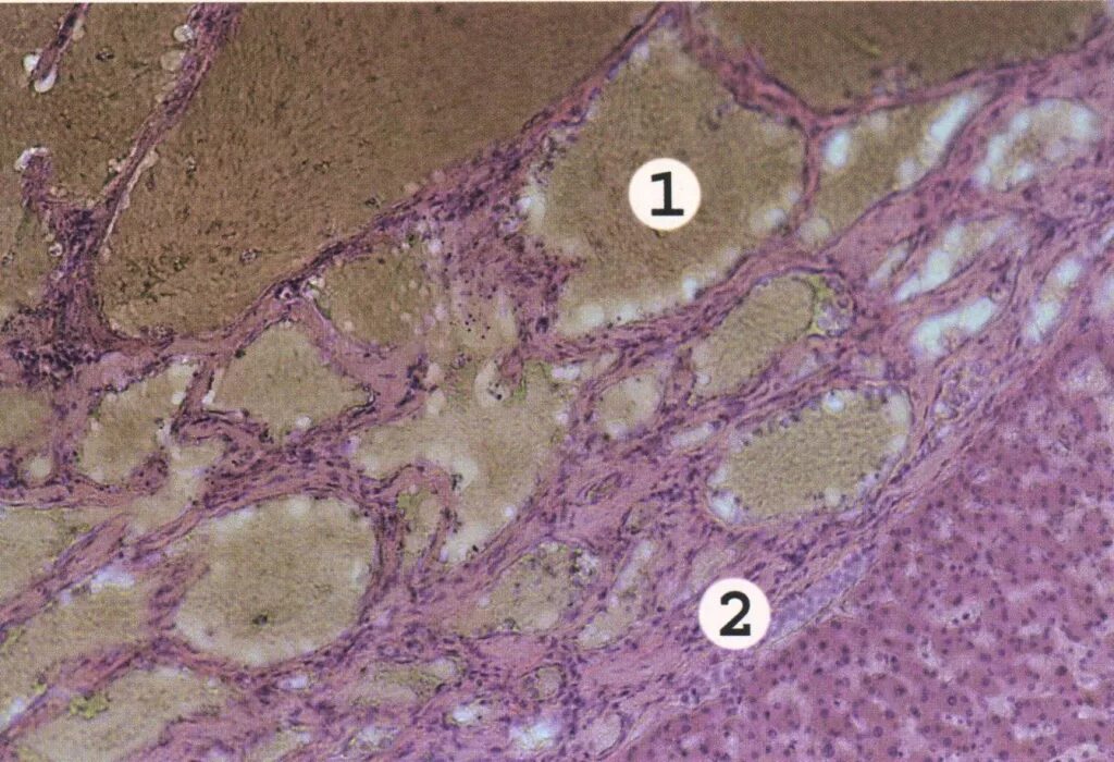 Удаление опухолей печени. Кавернозная гемангиома гистология. Кавернозная гемангиома патанатомия. Капиллярная гемангиома патанатомия. Гемангиома печени микроскопия.