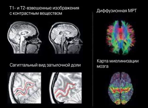Диффузные изменения вещества головного мозга. Диффузно тензорное мрт. картина очаговых изменений вещества головного мозга. диффузно взвешенная мрт. диффузионная мрт.