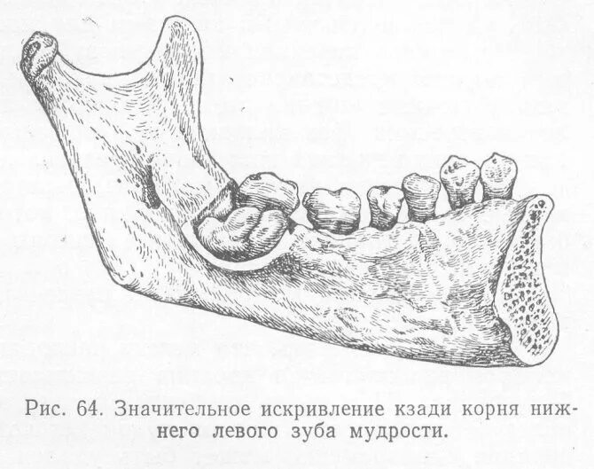 Зуб 8 корень. Третий моляр («зуб мудрости»): нижней челюсти. Корни зубов мудрости нижней челюсти. Корни у зубов нижней челюсти зуб мудрости. Корни 8 зуба верхней челюсти.