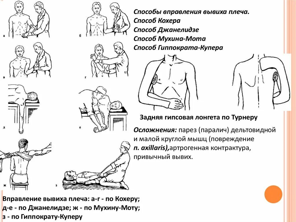 Лечение плеча после вправления. Метод вправления вывиха. Методы вправления вывиха плеча. Вправление вывиха метод Гиппократа. Вправление вывиха плеча Джанелидзе.