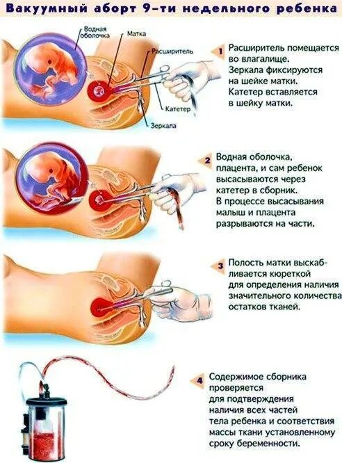 До какого срока можно делать обороты. Вакуумный аборт на 9 неделе беременности. мини-аборт (вакуум-аспирация). аборт на ранних сроках вакуумом. искусственный аборт методом вакуум - аспирации.