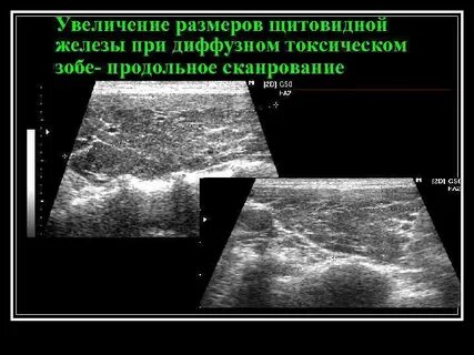 Уровень диффузного зоба