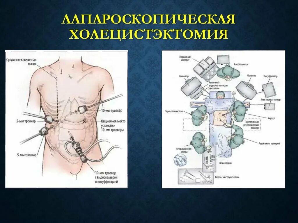 Месяц после холецистэктомии. Холецистэктомия троакары. Лапароскопическая холецистэктомия. Лапароскопия холецистэктомия ход операции. Холецистэктомия разрез.