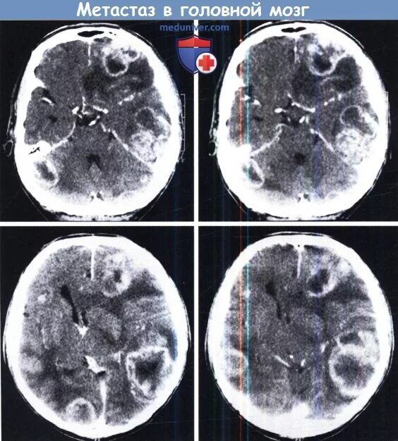 Лечение метастазов мозга. Метастазы в головном мозге. Метастазирование опухолей головного мозга. Метастазы меланомы в головной мозг. Опухоль головного мозга метастазы.