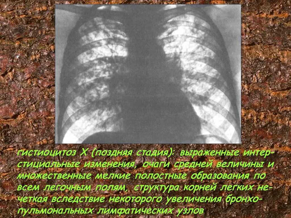 Множественные полостные образования в легких. Полостные образования в легких на кт. Редкие заболевания легких. Полостные образования в легких