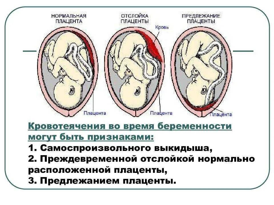Отслойка плаценты: причины и симптомы на разных сроках, лечение и последствия