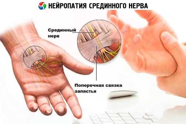 Компрессионная нейропатия локтевого нерва. Нейропатия срединного нерва. Компрессионная нейропатия лучевого нерва. Нейропатия кисти