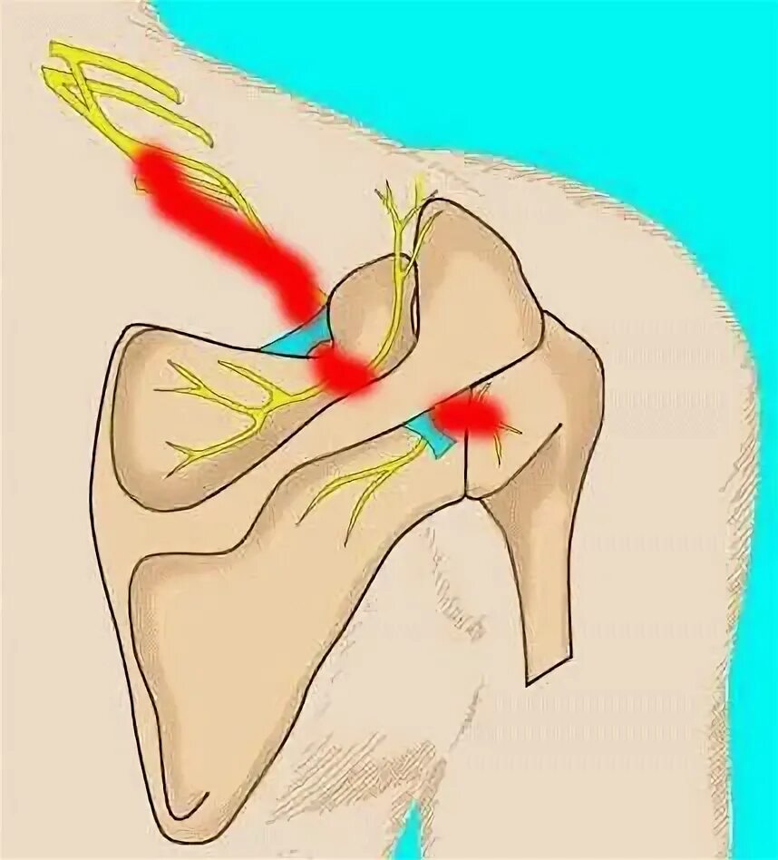 Лопаточно плечевой сустав. N suprascapularis. Болит лопатка. Защемило нерв под лопаткой слева. Массаж при защемлении нерва в спине.
