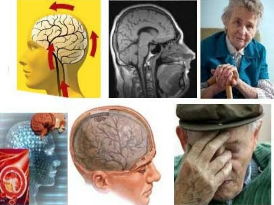 Энцефалопатия мозга последствия. Дисциркуляторная энцефалопатия мозга. Дисциркуляторная энцефалопатия головного мозга (Дэп). Энцефалопатия головного мозга что это такое. Ишемия головного мозга снимок.