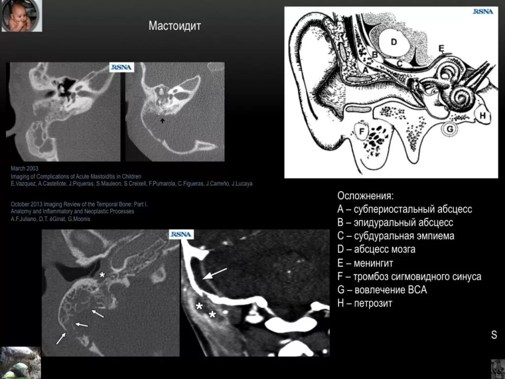 Сосцевидный отросток височной кости кт. Кт анатомия сосцевидного отростка. Мастоидит височной кости кт. Анатомия височной кости кт. Утолщение слизистой сосцевидного отростка