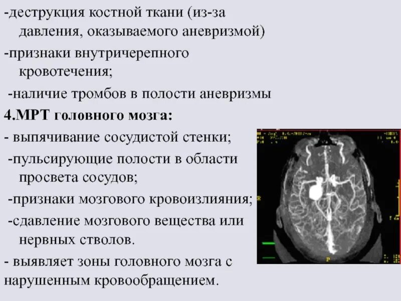 Аневризма головного мозга. Аневризм головного мозга. Аневризмы сосудов головного мозга. Аневризм артерий головного мозга. Аневризма мозга простыми словами