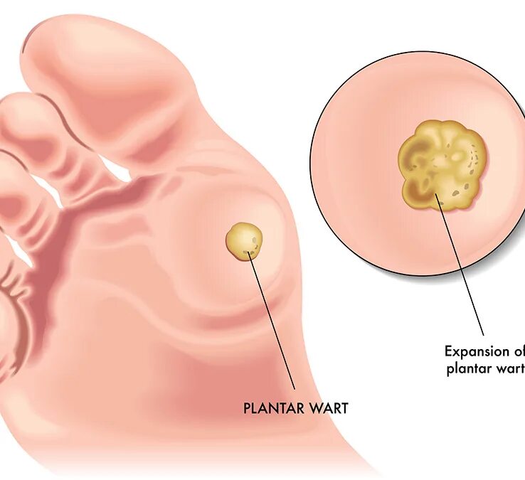 Вирусная подошвенная бородавка. Шипишка подошвенная бородавка. Подошвенная бородавка вирусная инфекция. Остроконечных кондилом и папиллом.