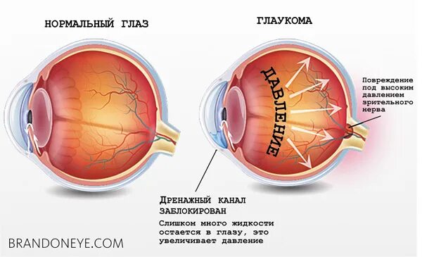 Глаукома строение глаза. Глаукома схема глаза. Анатомия глаза внутриглазное давление. Строение глаза патология глаукома.